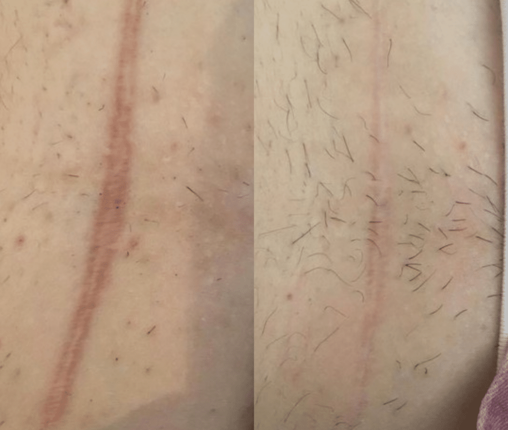 Bloomea partner institute example: a body scar before, on the left, and after eight sessions, on the right