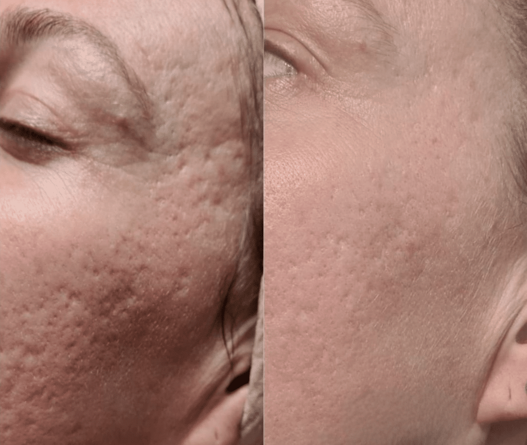 Bloomea partner institute example: post-acne marks before, on the left, and after four sessions, on the right