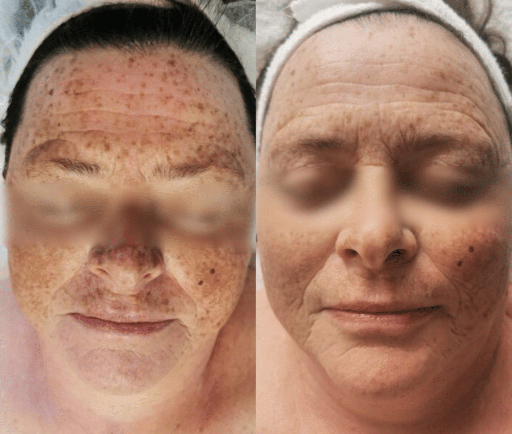 Bloomea partner institute example: facial pigmentation before, on the left, and after six sessions, on the right